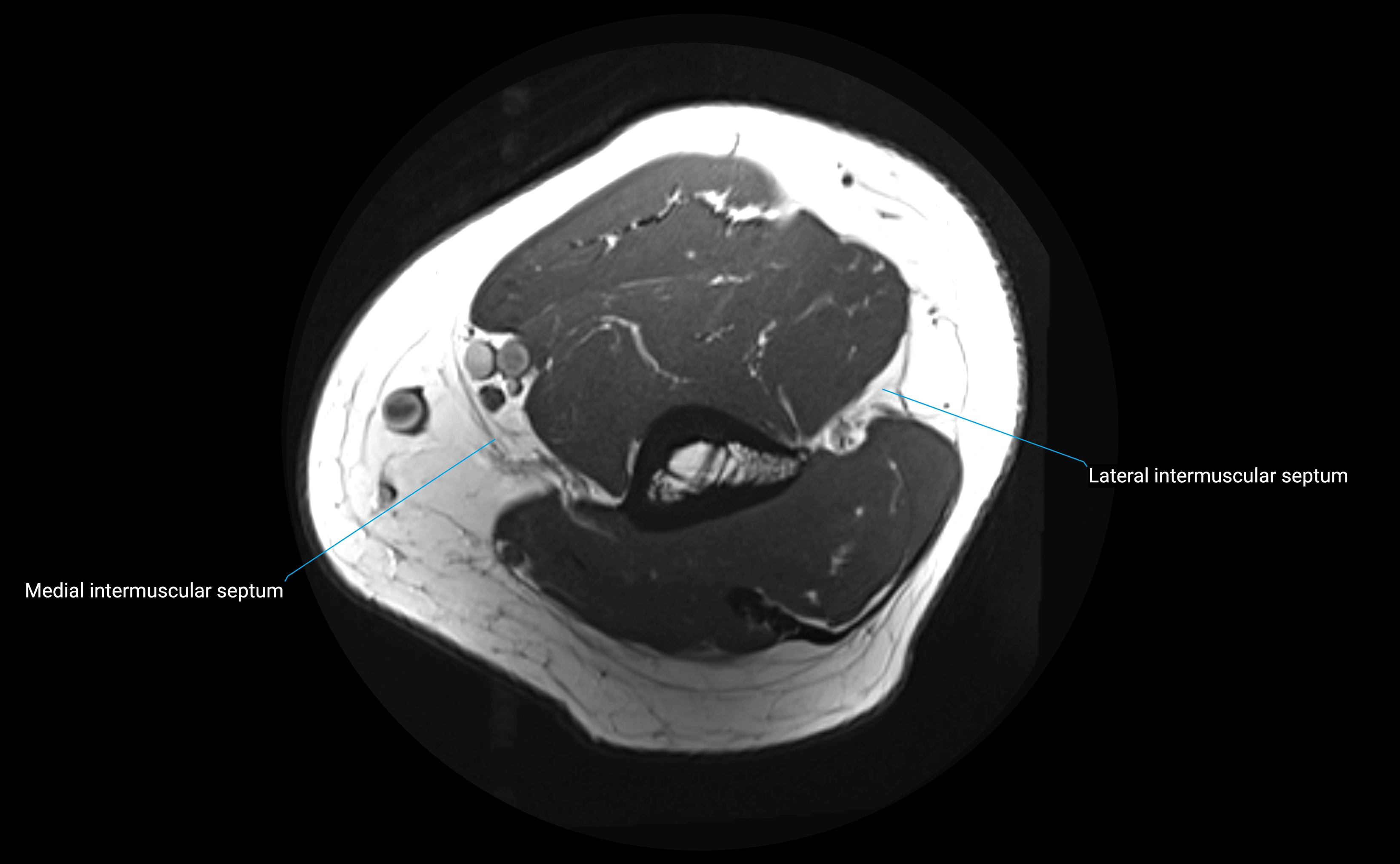 MRI elbow ligaments axial cross sectional anatomy 3T  radiology  image-img-00001-00002.webp